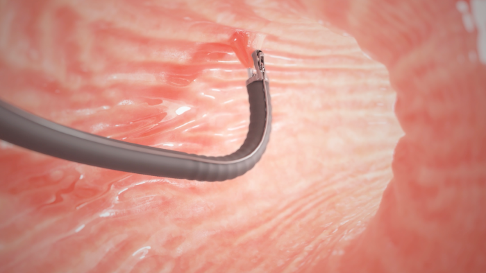 Endoscope inserted