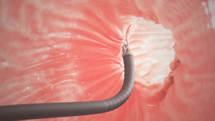 Suture line created